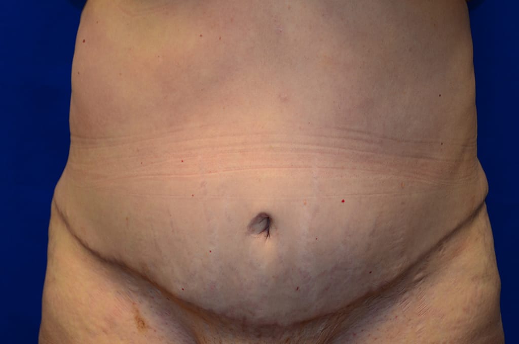 Case 1 Mommy Makeover - Stomach close-up