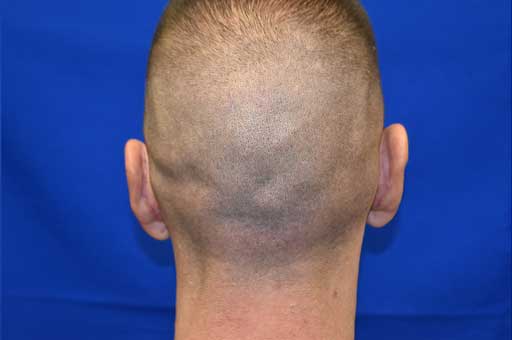 Case 1 Otoplasty - Back view