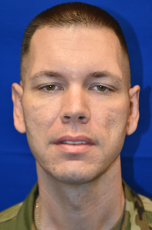 Case 1 Otoplasty - Full front view