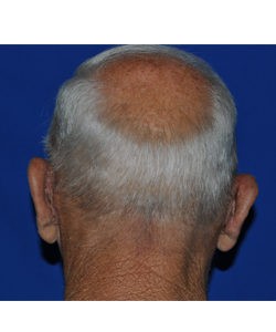 Case 2 Otoplasty - Back view