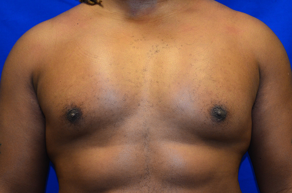 Case 1 Pectoral Augmentation - Front view