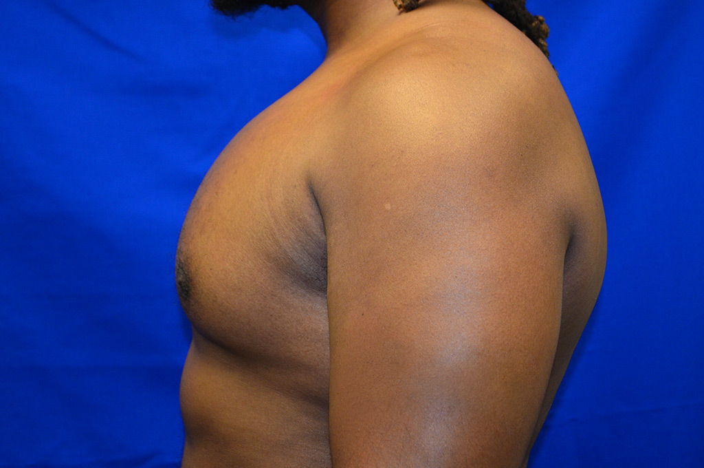 Case 1 Pectoral Augmentation - Left side