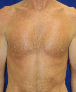 Case 2 Pectoral Augmentation - Front view