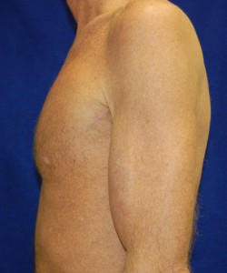 Case 2 Pectoral Augmentation - Side view