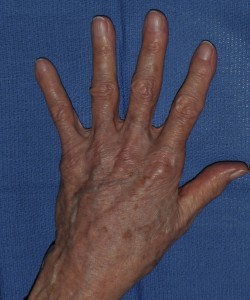 Case 1 Radiesse - Left side