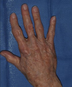 Case 1 Radiesse - Right side