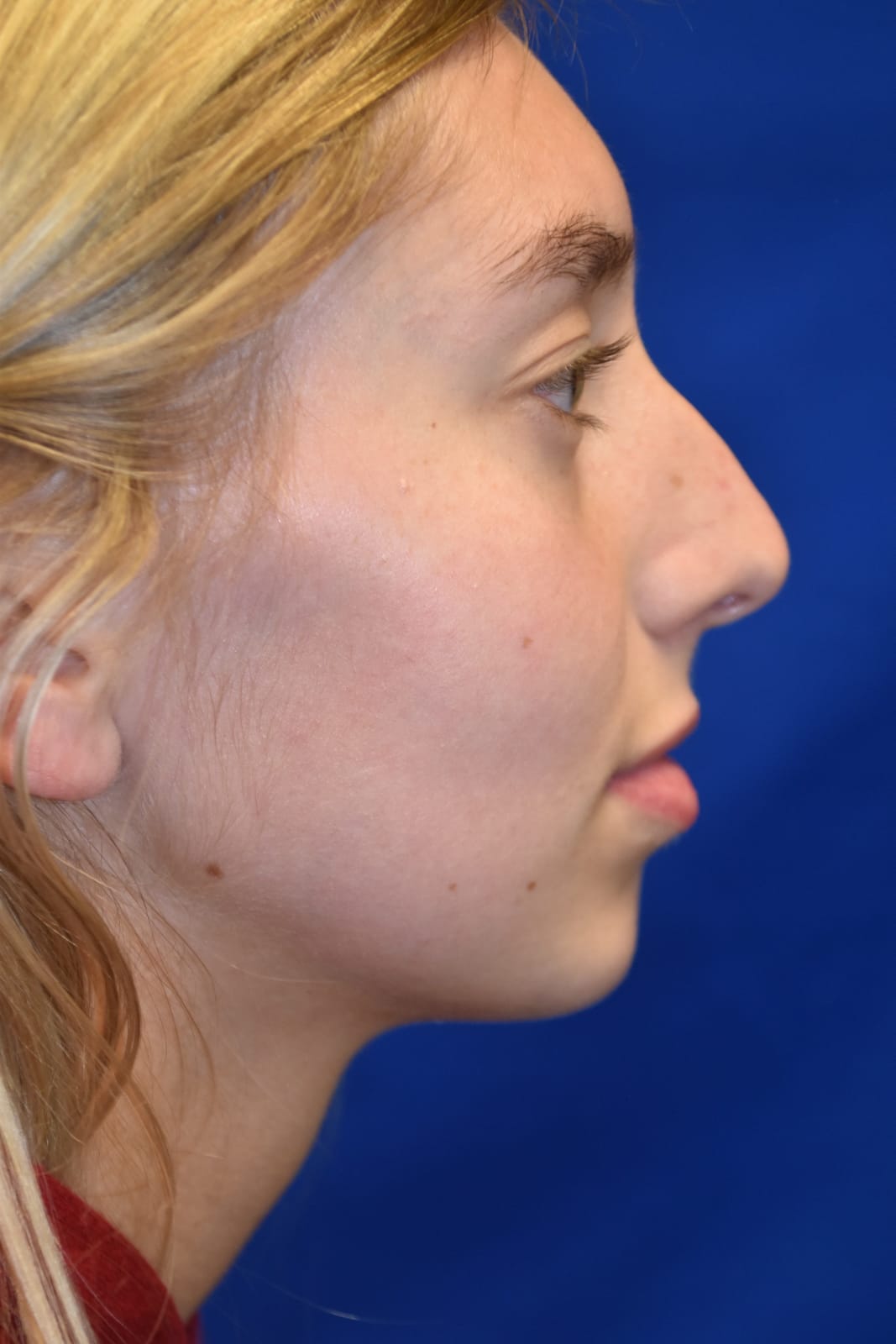 Case 2 Rhinoplasty - Right profile