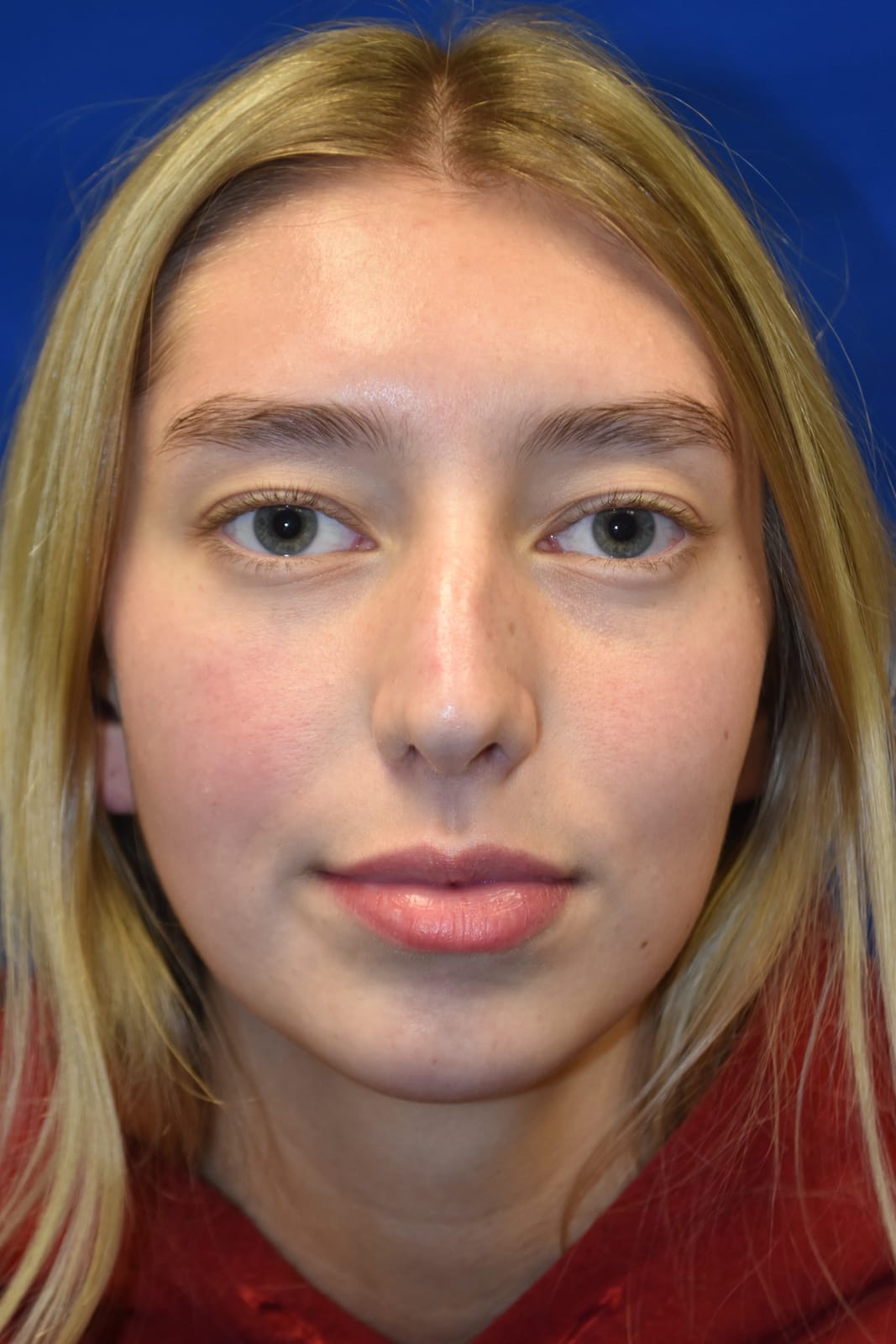 Case 2 Rhinoplasty - Front view