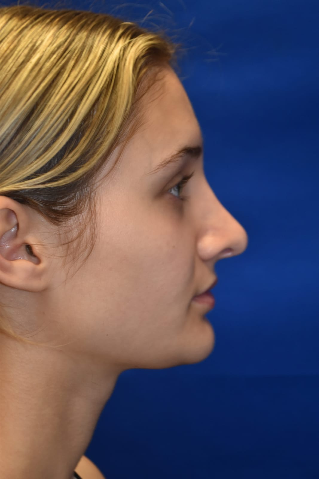 Case 3 Rhinoplasty - Front view