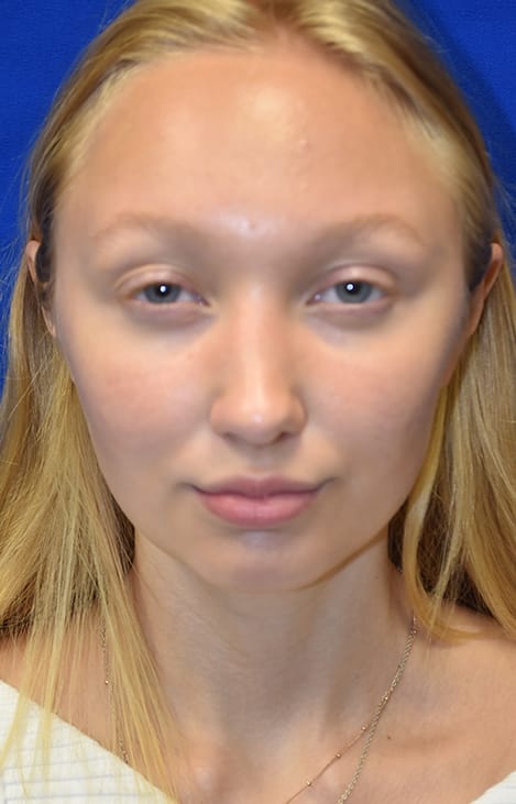 Case 4 Rhinoplasty - Front view
