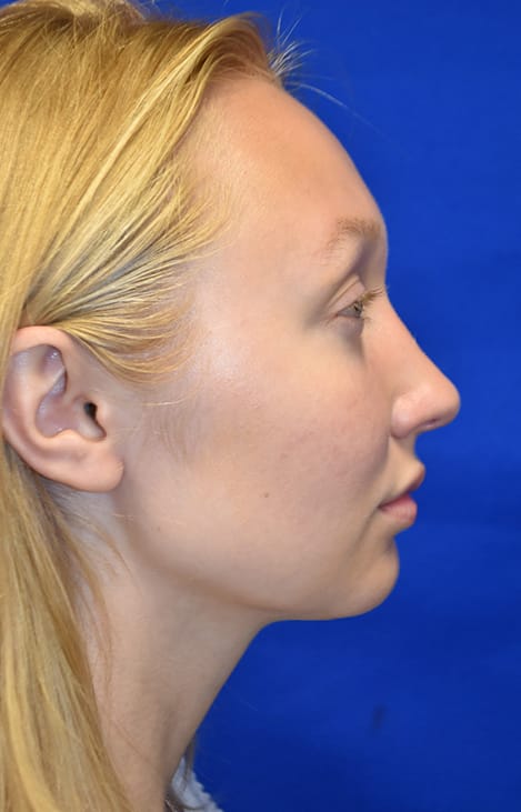 Case 4 Rhinoplasty - Right profile