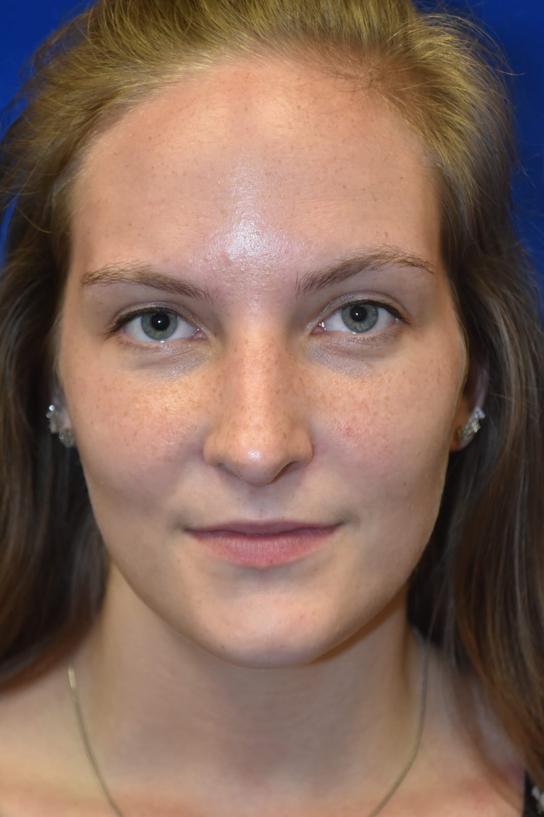 Case 5 Rhinoplasty - Front view
