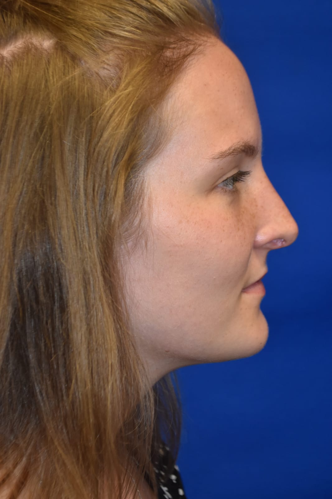 Case 5 Rhinoplasty - Right profile