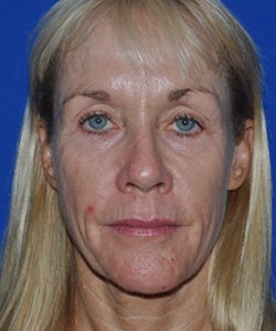 Case 1 Sculptra - Front view
