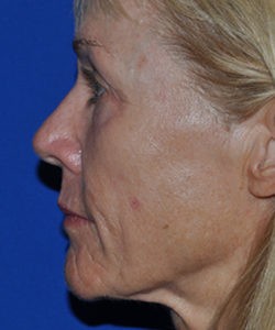 Case 1 Sculptra - Left side