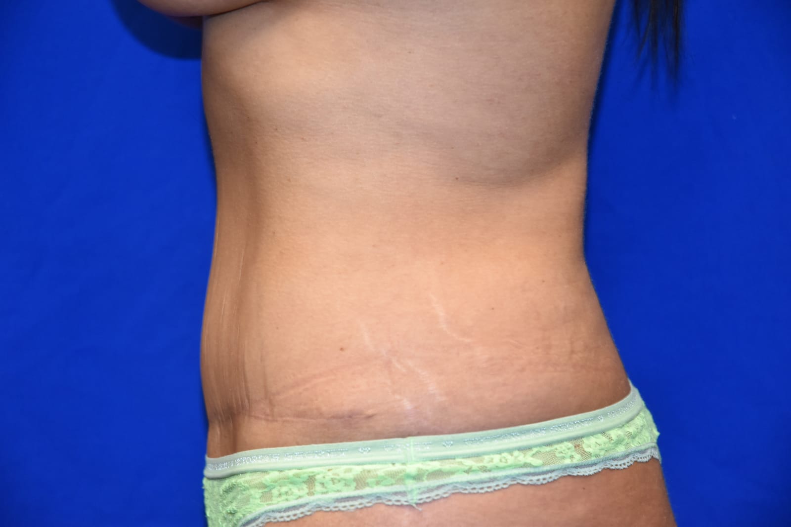 Case 1 Tummy Tuck - Oblique view