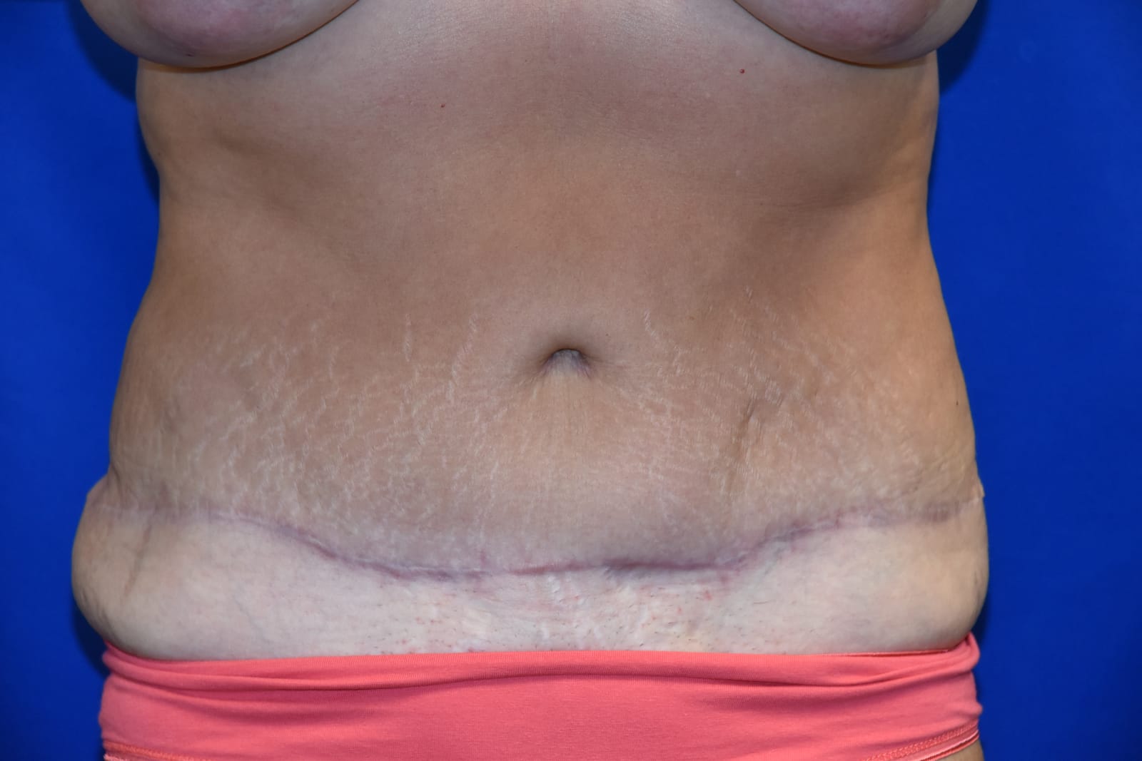 Case 10 Tummy Tuck - Front view