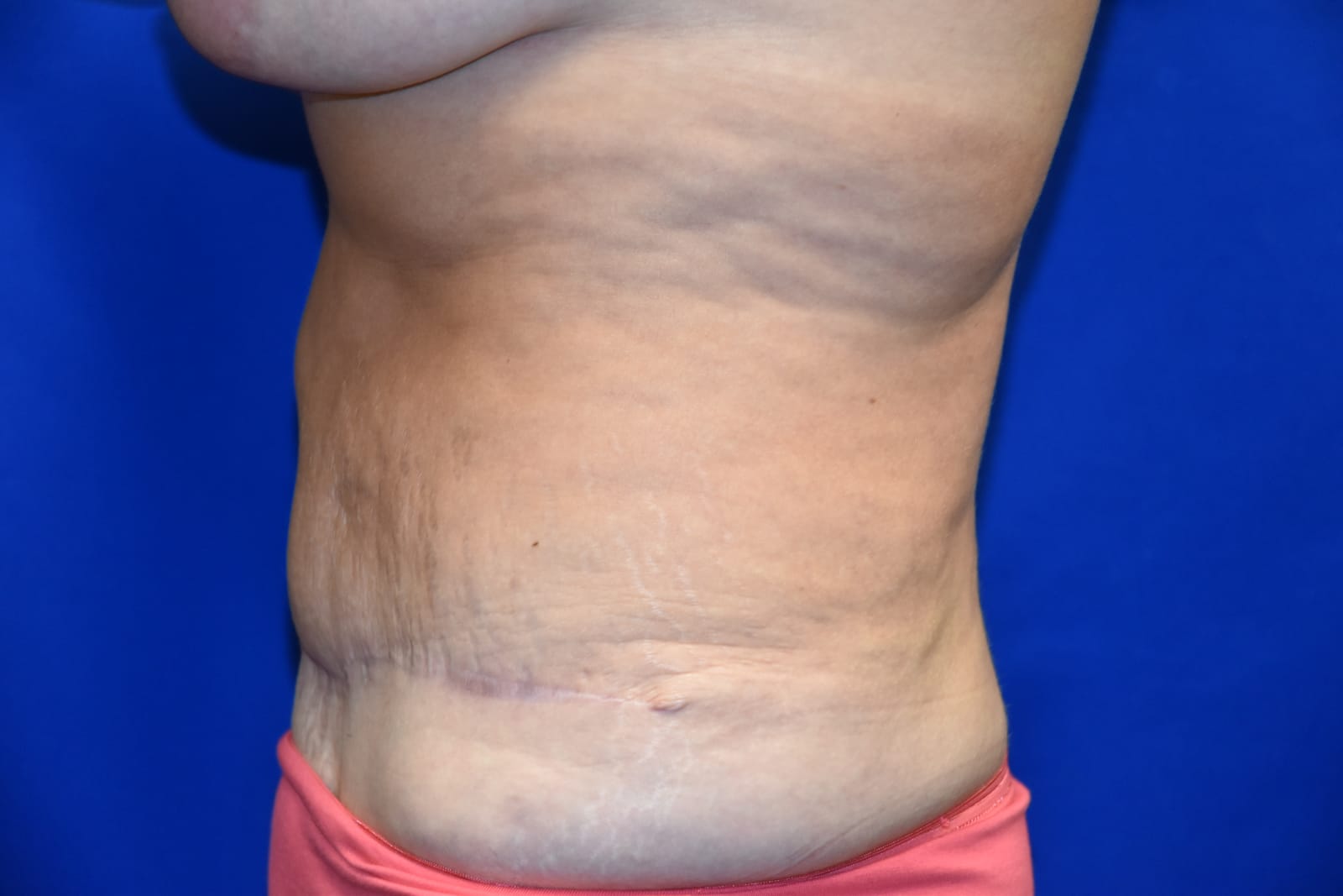 Case 10 Tummy Tuck - Oblique view