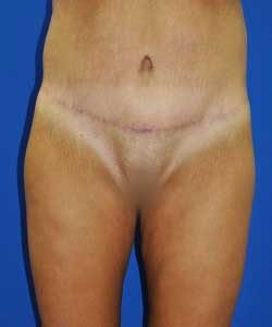 Case 11 Tummy Tuck - Front view