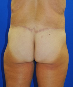 Case 11 Tummy Tuck - Oblique view