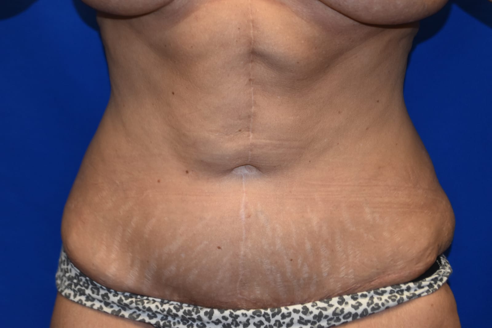 Case 2 Tummy Tuck - Front view