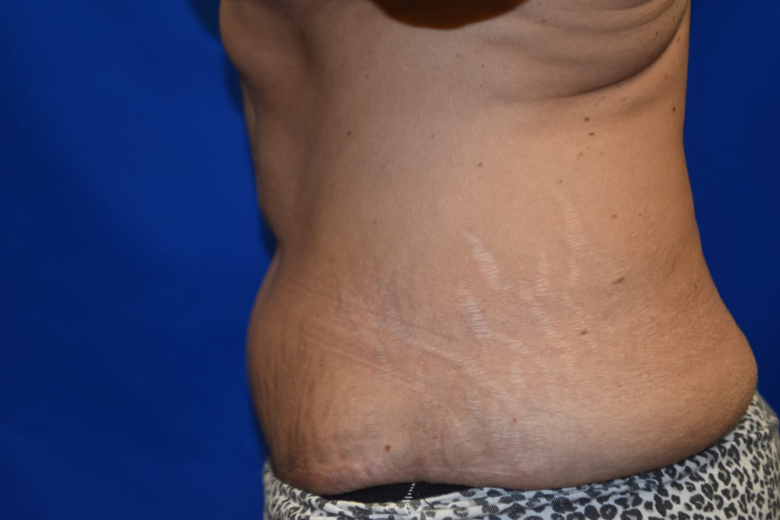 Case 2 Tummy Tuck - Oblique view