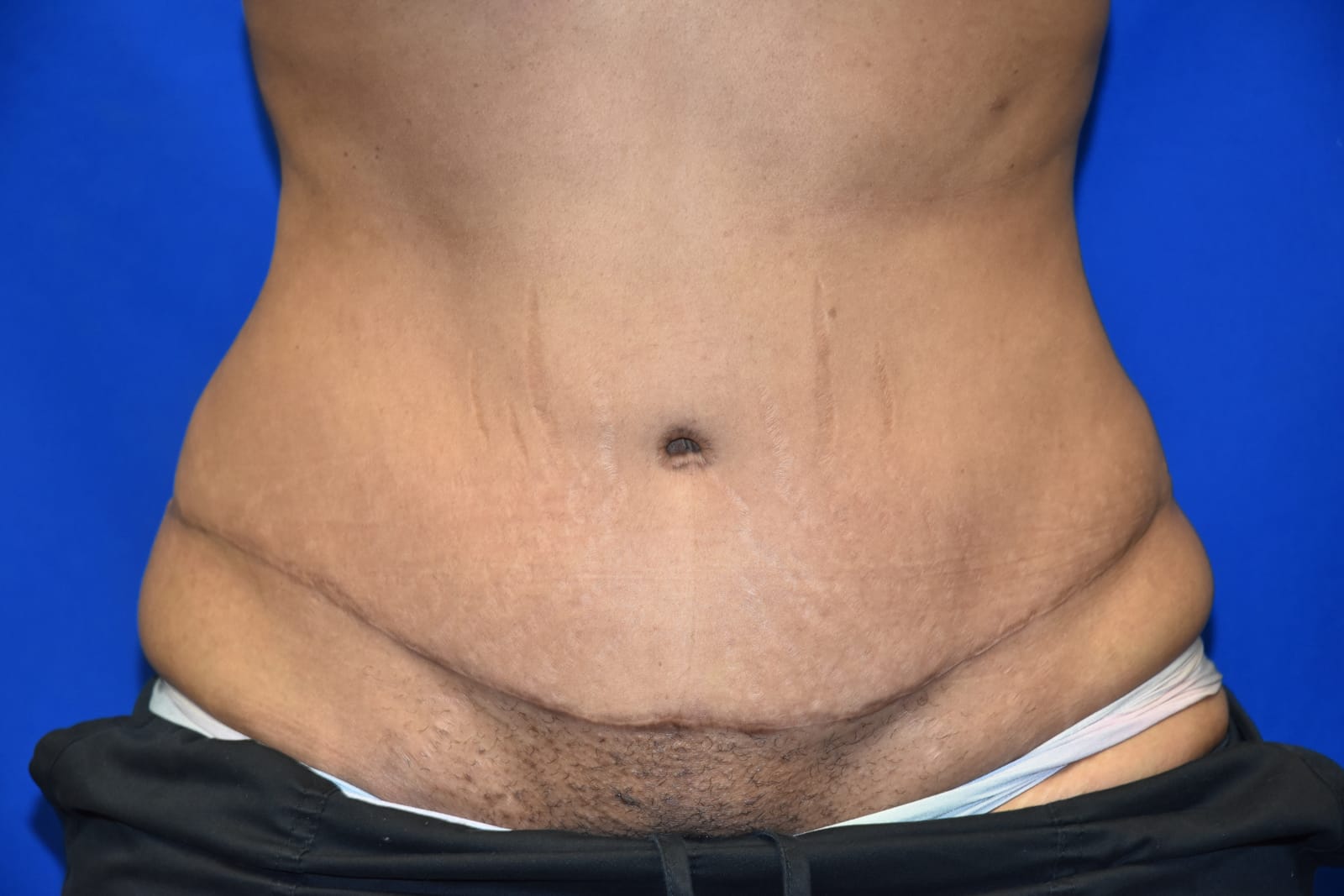 Case 3 Tummy Tuck - Front view