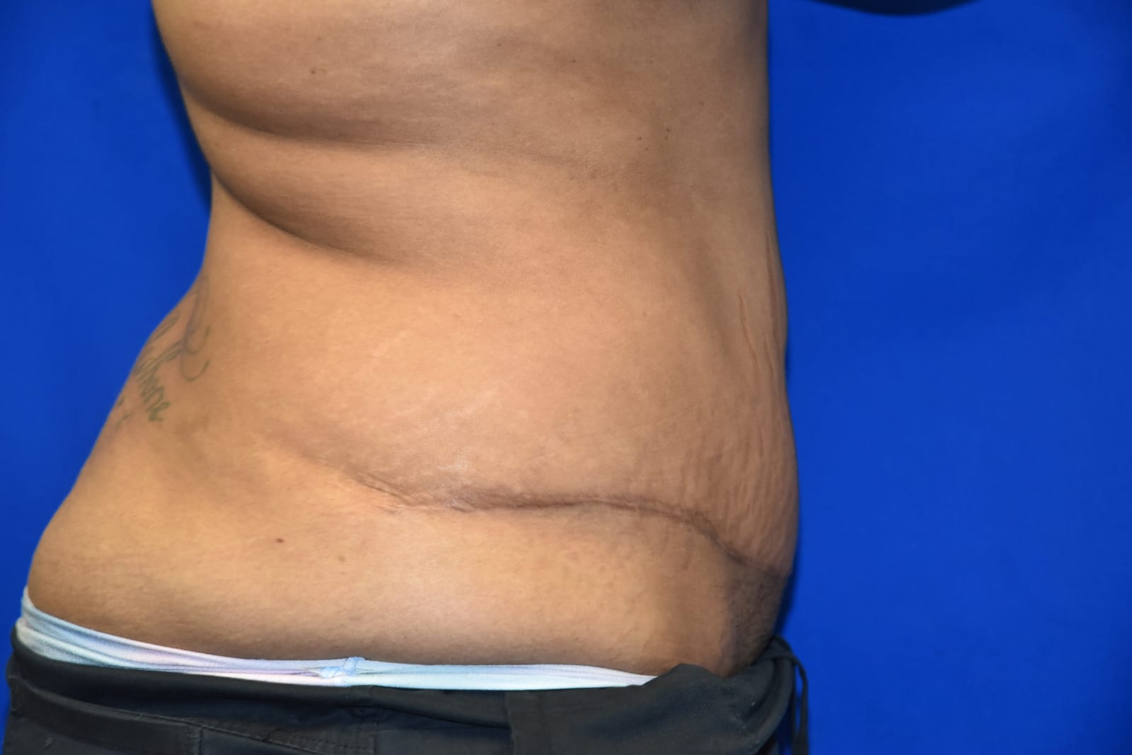 Case 3 Tummy Tuck - Oblique view