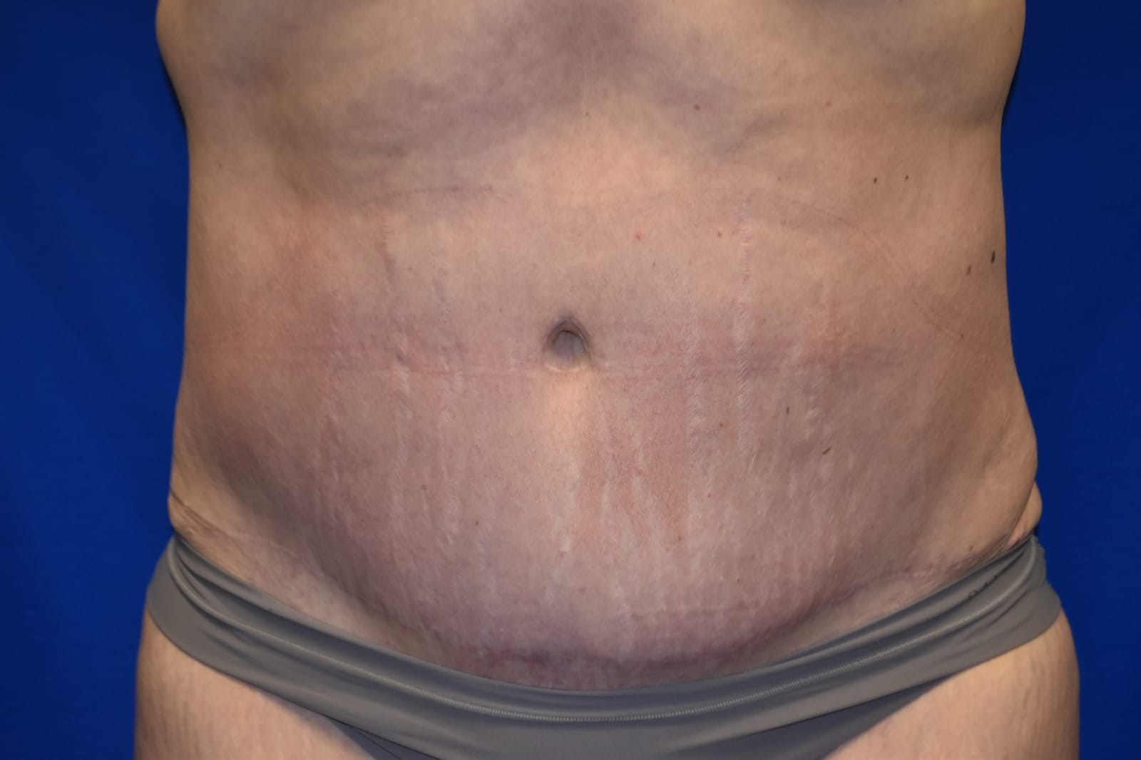 Case 4 Tummy Tuck - Front view