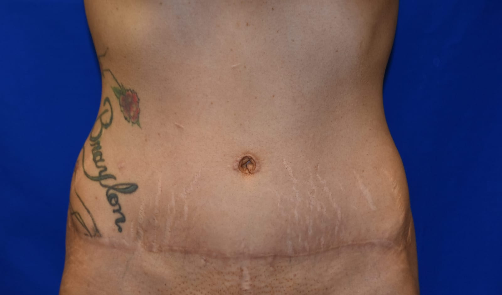 Case 5 Tummy Tuck - Front view