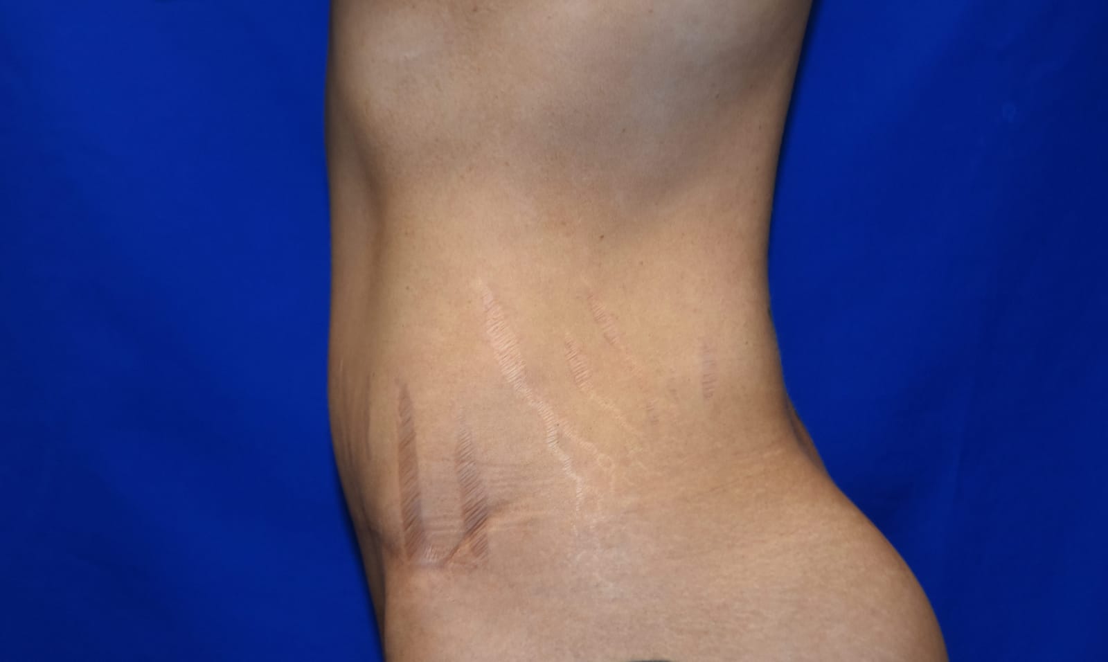 Case 5 Tummy Tuck - Oblique view
