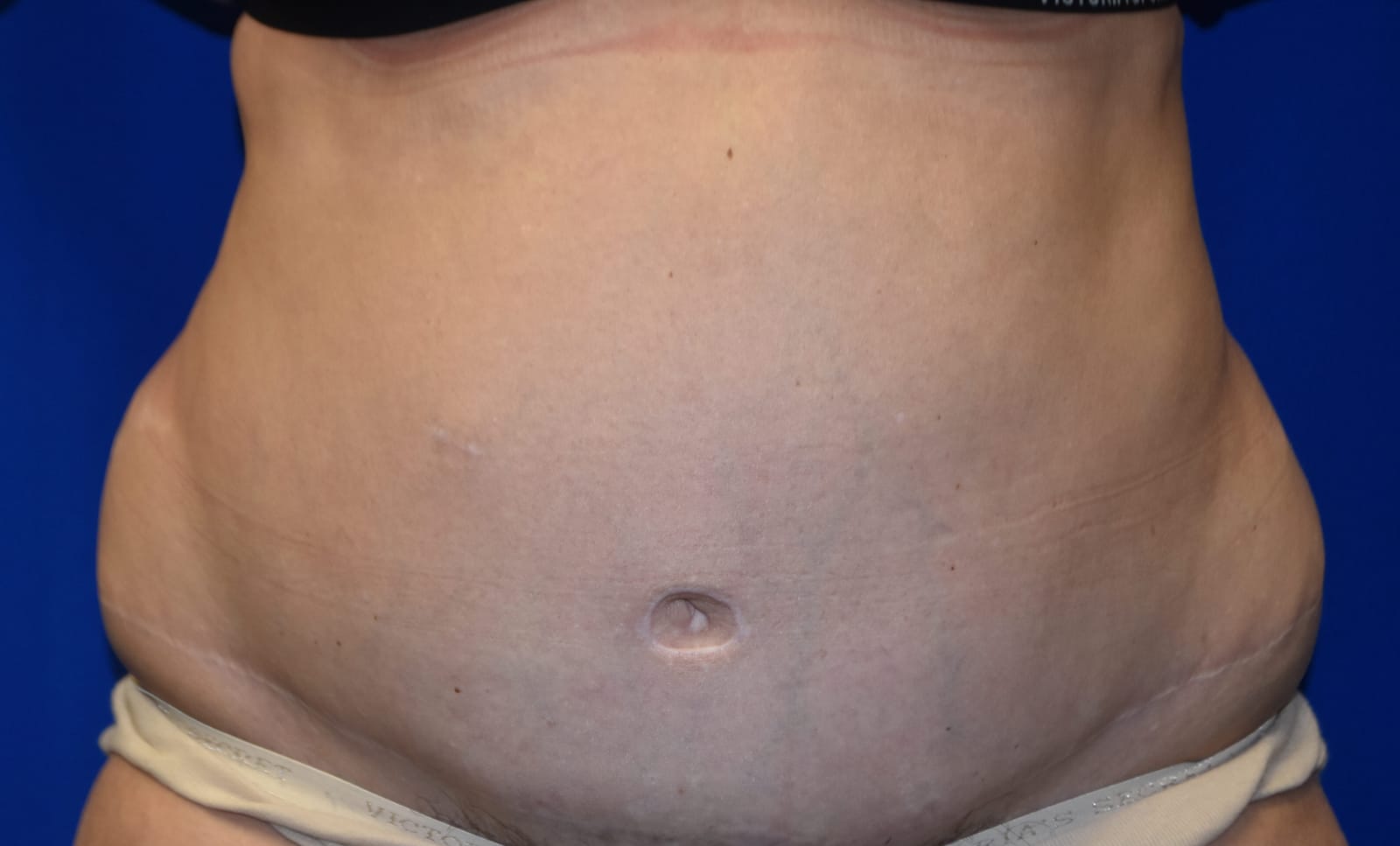 Case 6 Tummy Tuck - Front view