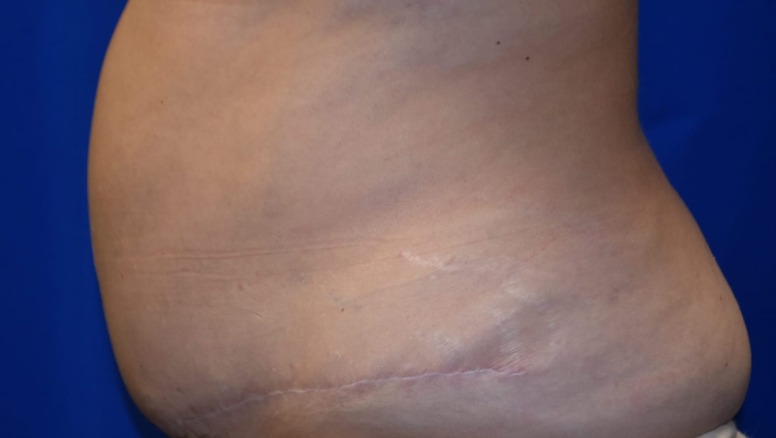Case 6 Tummy Tuck - Oblique view