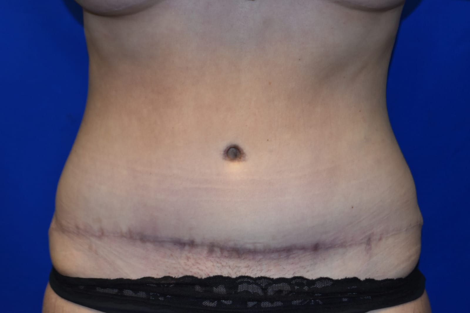 Case 7 Tummy Tuck - Front view