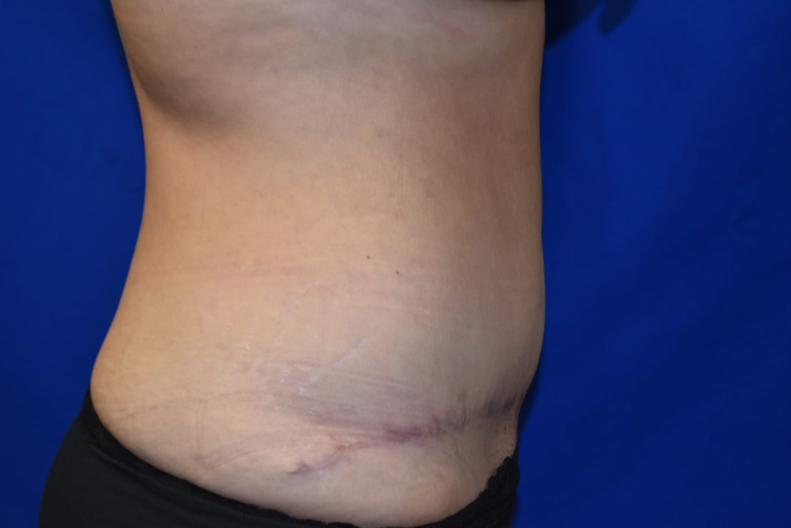 Case 7 Tummy Tuck - Oblique view