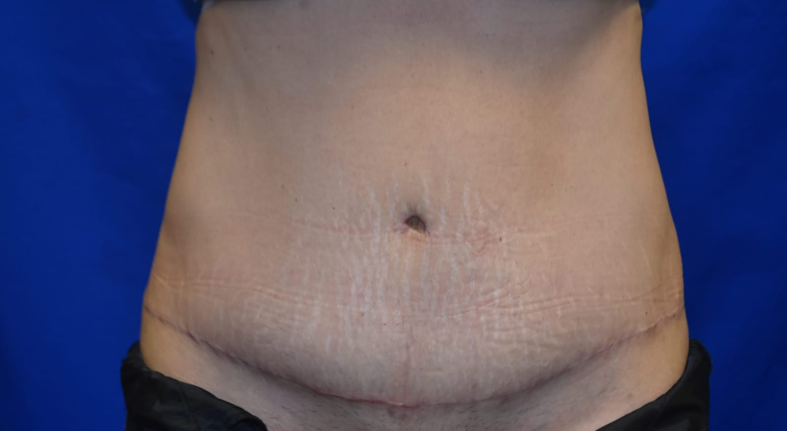 Case 8 Tummy Tuck - Front view