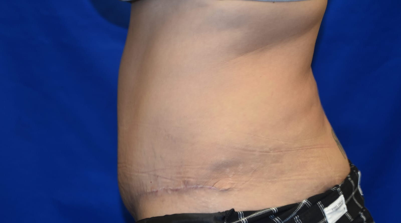 Case 8 Tummy Tuck - Oblique view