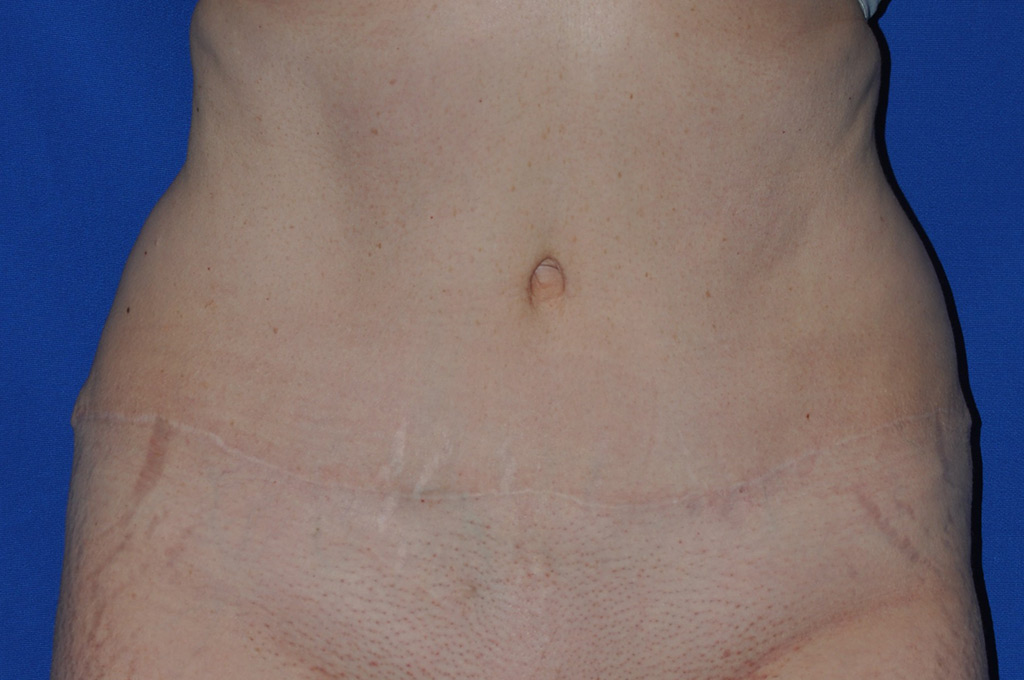 Case 9 Tummy Tuck - Front view