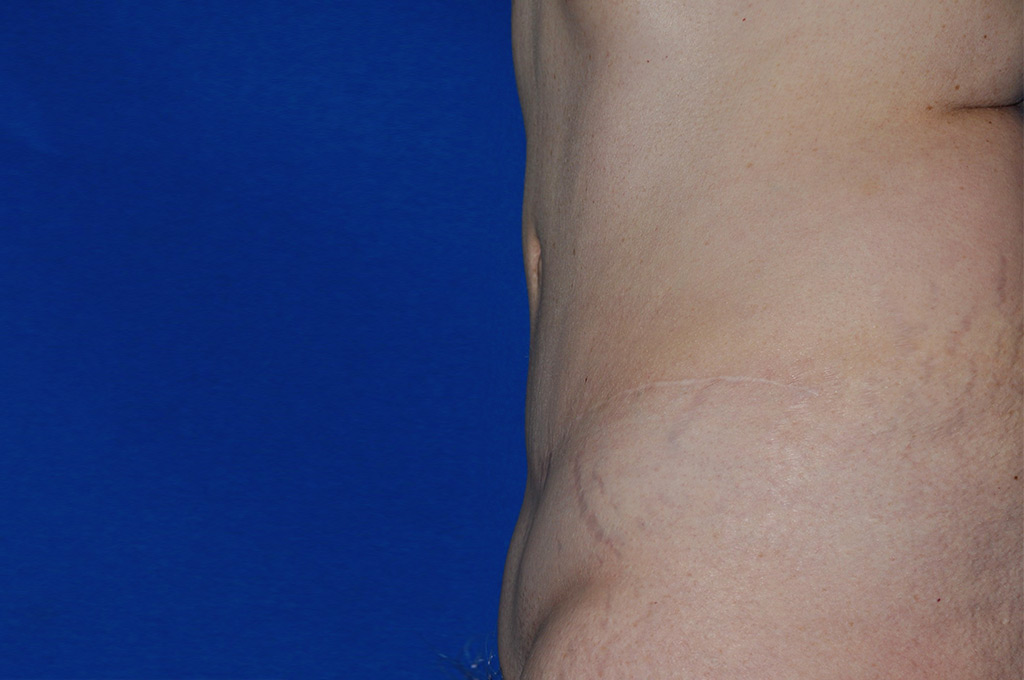 Case 9 Tummy Tuck - Oblique view